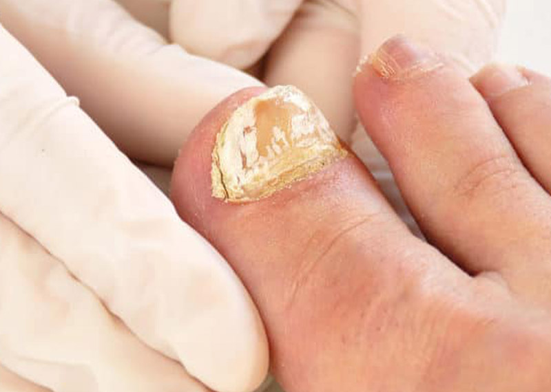 آیا پسوریازیس ناخن درمان قطعی دارد؟
